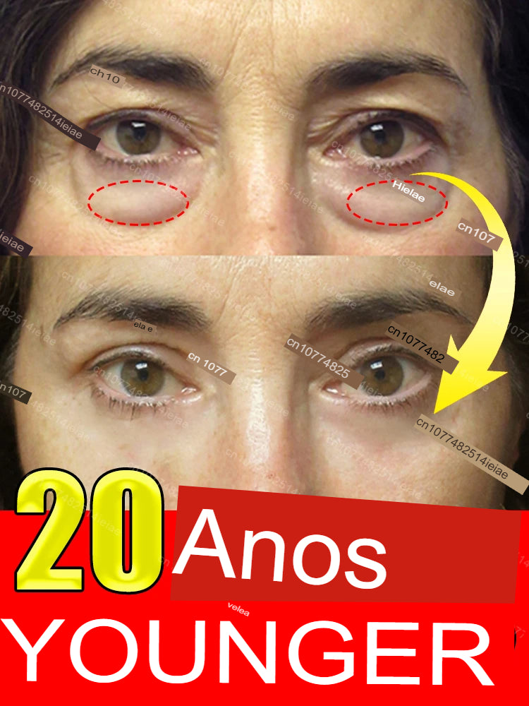 Remove instantaneamente bolsas sob os olhos