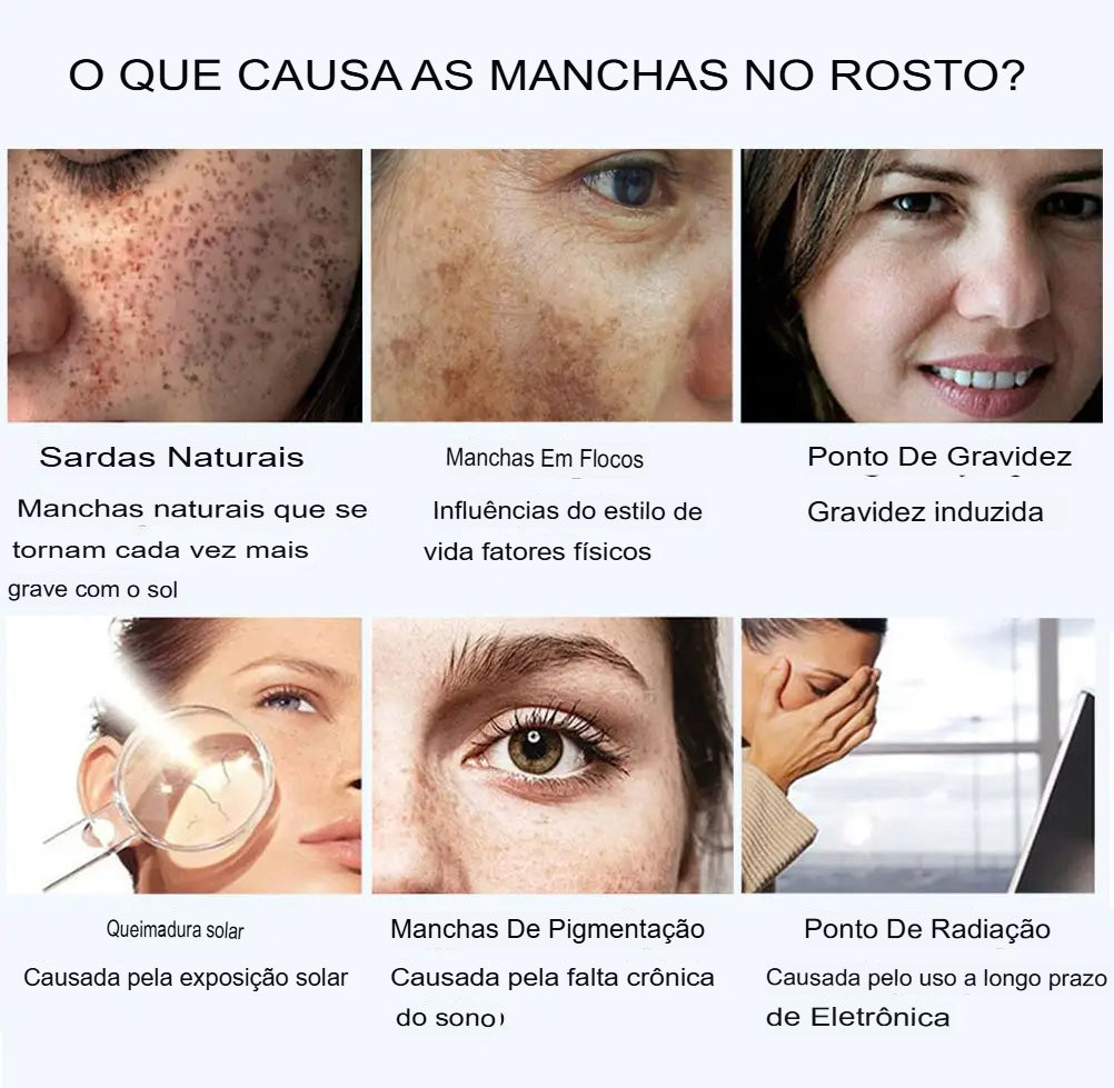 Creme contra Manchas solares cloasma arbutin anti-envelhecimento iluminando