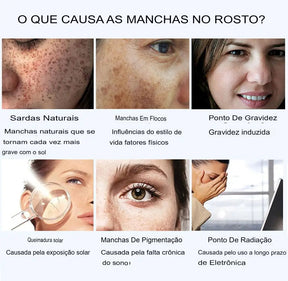 Creme contra Manchas solares cloasma arbutin anti-envelhecimento iluminando